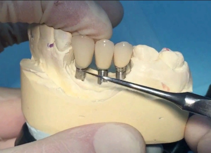 Имплантация зубов в Балашихе