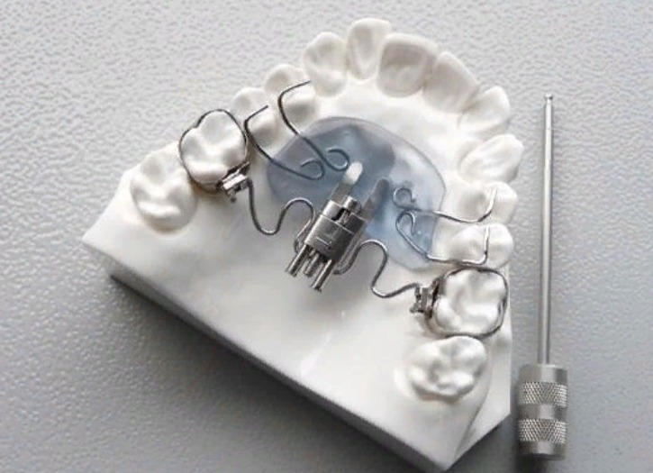 Ортодонтические пластинки несъемные