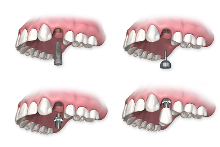 Этапы имплантации зубов