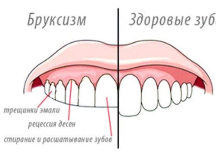 Бруксизм – непроизвольный скрип зубов, как избавиться