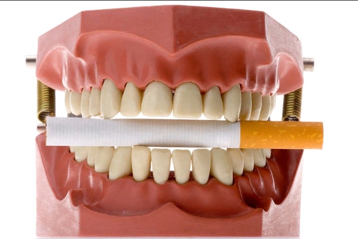 Уход за зубными имплантами