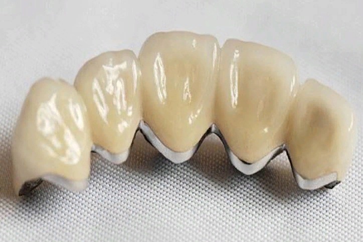Коронка на передний зуб