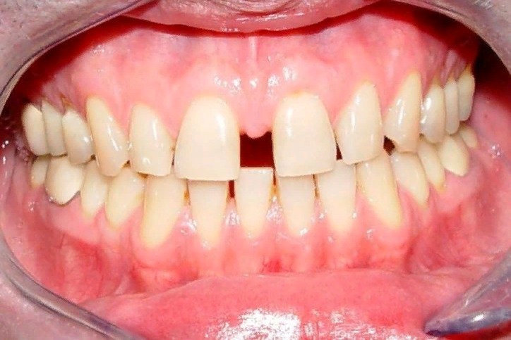 щель между зубами