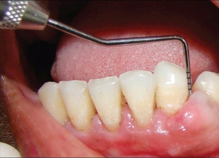 Удаление зубов в Балашихе