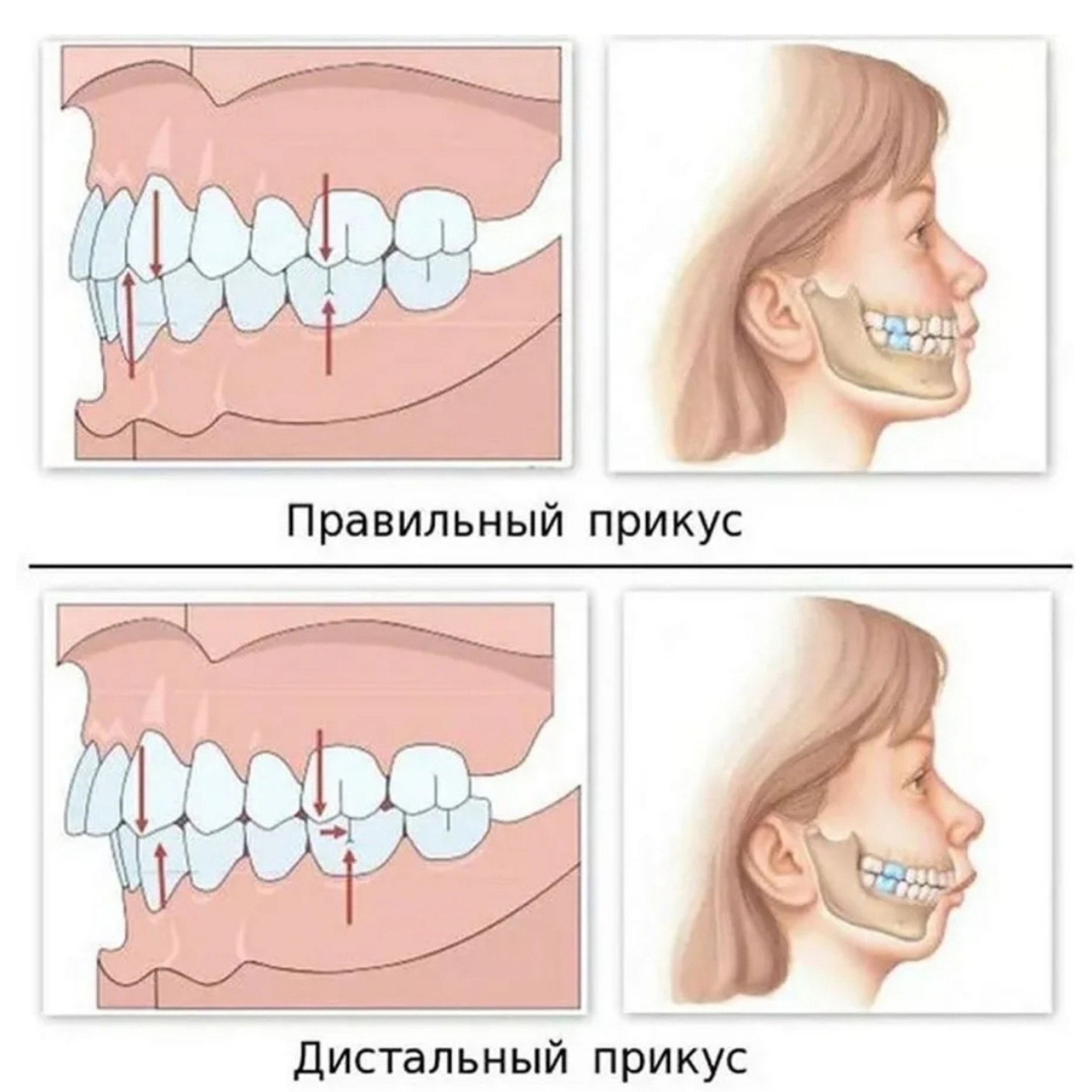Удаление корня зуба