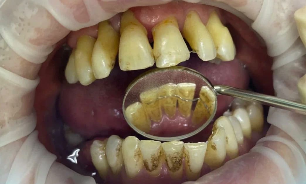 Протезирование зубов на имлантах