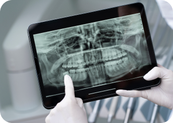 Оценка состояния полости рта перед имплантацией зубов
