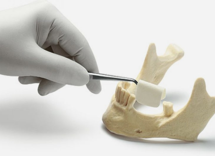 Имплантация зубов в Балашихе