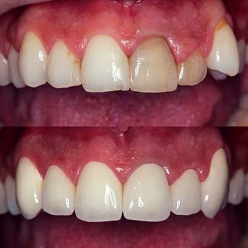 Восстановление зуба коронкой