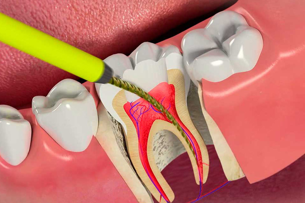 Пломбировка зубных каналов