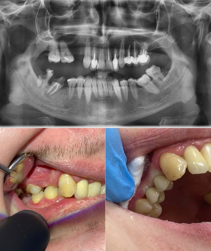 Удаление зуба с последующей имплантацией