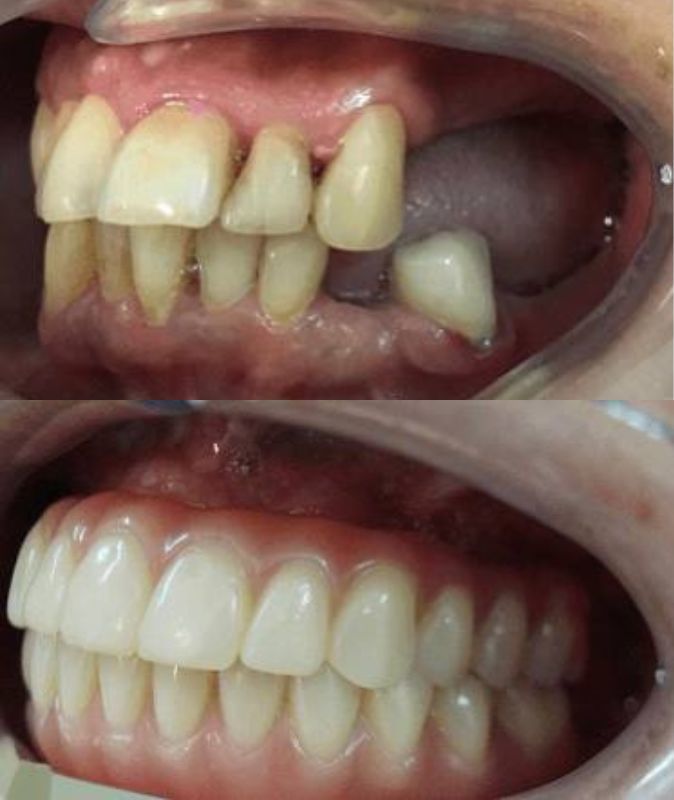 Протезирование всех зубов
