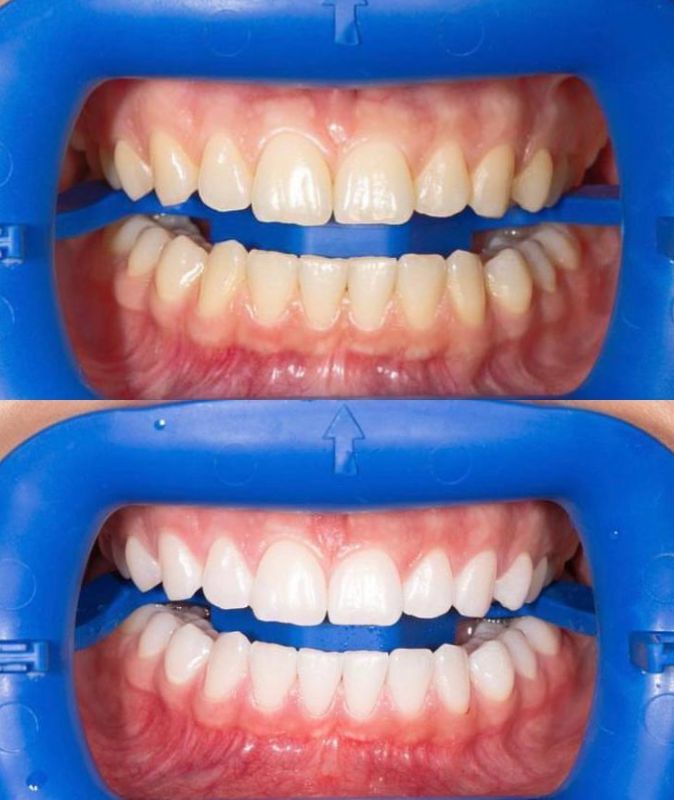otbelivanie-zubov-1